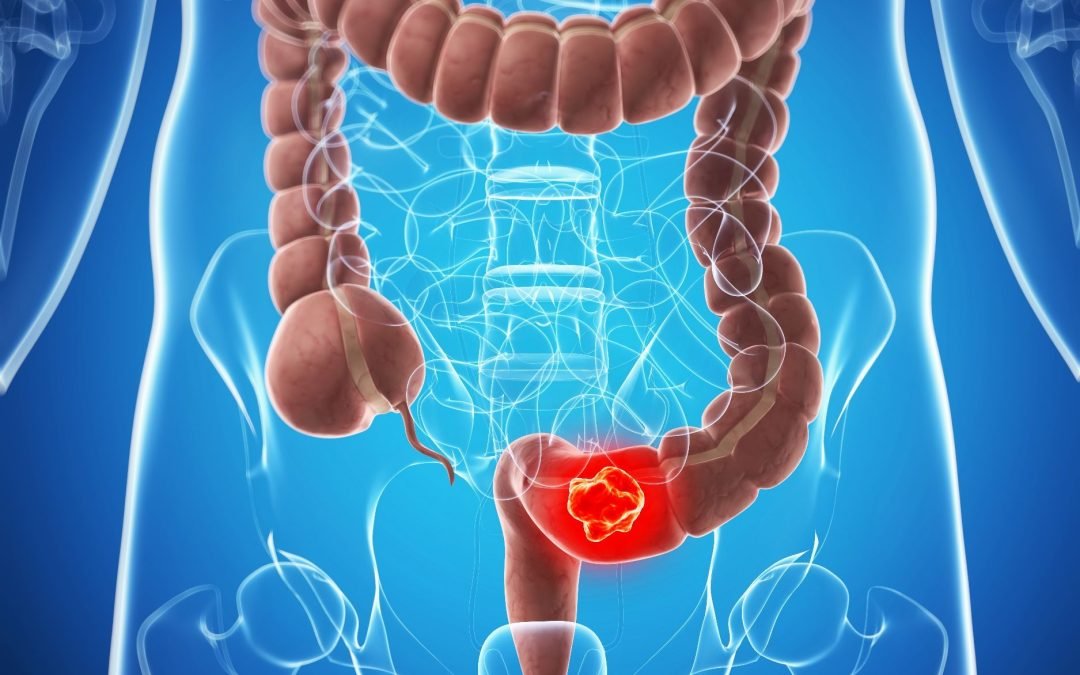 12 hábitos para prevenir brotes de colitis ulcerosa y  reducir posibilidades de un cáncer colorrectal