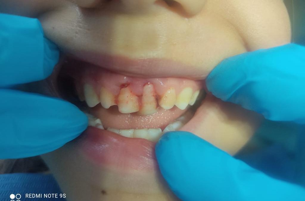 Entre el 15% y 40% de los niños sufren  de un trauma dental en la infancia