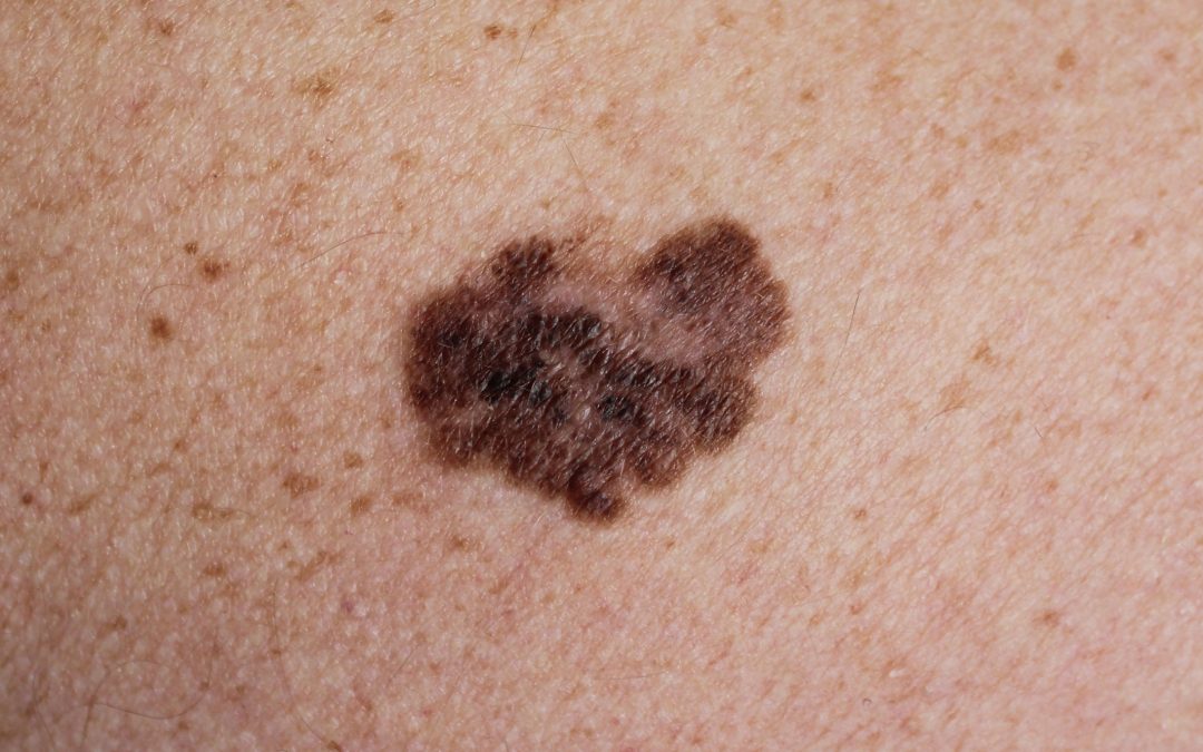 ¡Cuídese de los rayos UV! Tener cinco o más quemaduras solares  duplica el riesgo de un melanoma