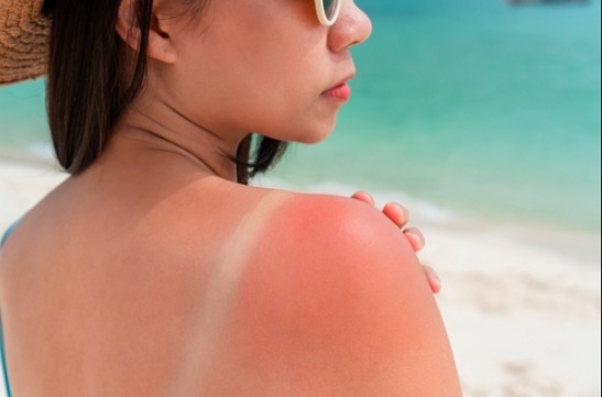 Consejos para el cuidado de la piel en Semana Santa Recuerde que la nutrición y protección solar hablarán a través de la piel