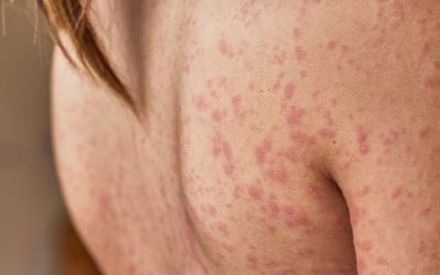 La dermatitis atópica impacta el bienestar social y emocional de quienes la padecen