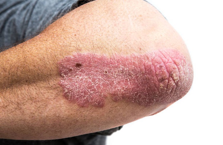 La psoriasis es un enigma en la medicina Es una guerra entre el sistema inmunitario y el cuerpo